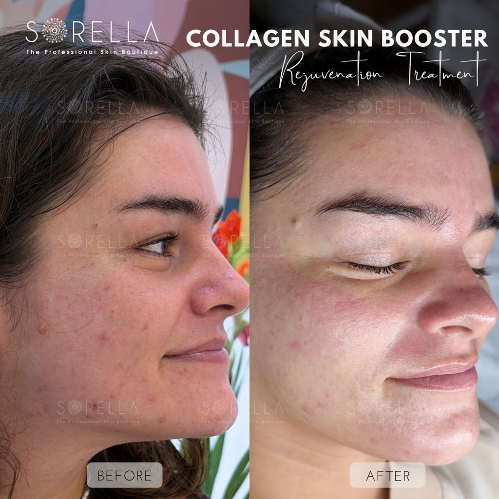 Before and after: Collagen Skin Booster at Sorella