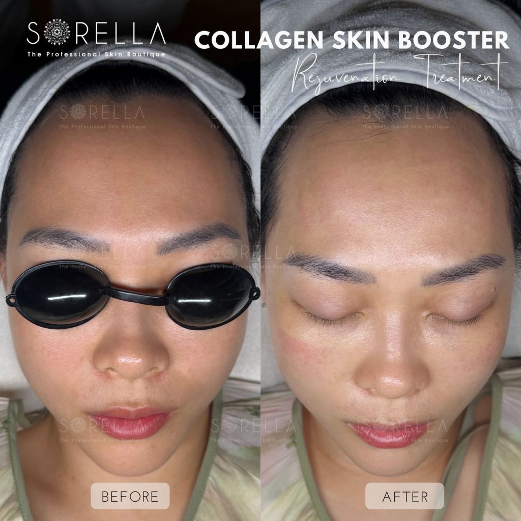 Before and after: Collagen Skin Booster at Sorella