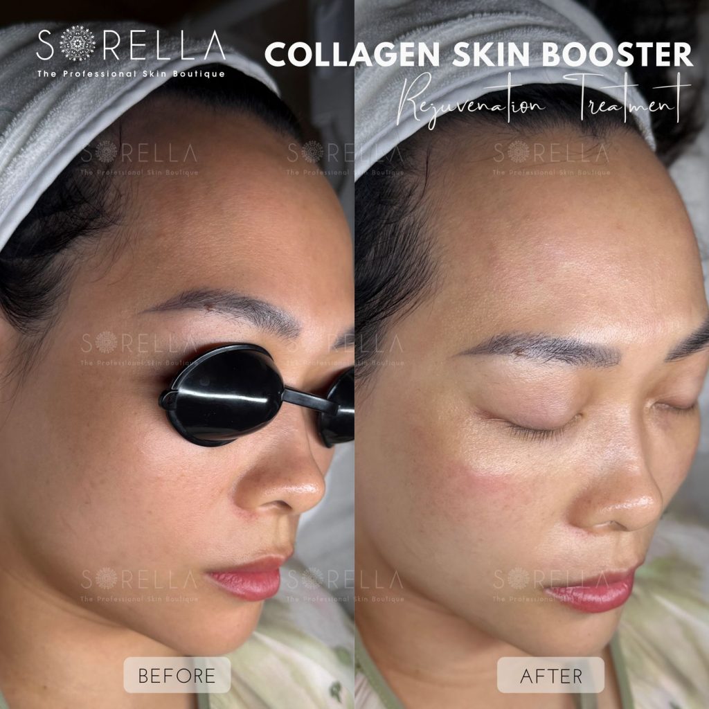 Before and after: BAP Rejuvenation – Collagen Skin Booster at Sorella