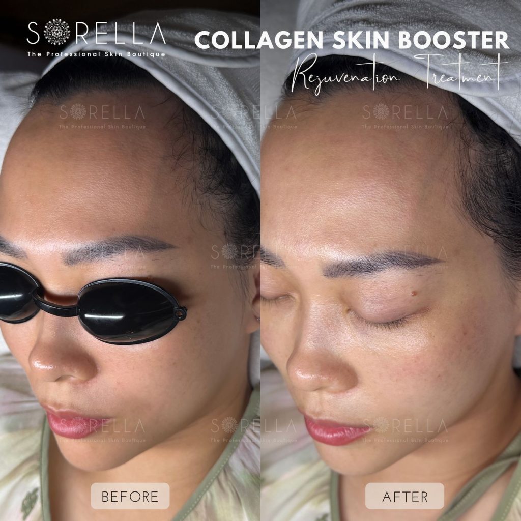 Before and after: BAP Rejuvenation – Collagen Skin Booster at Sorella