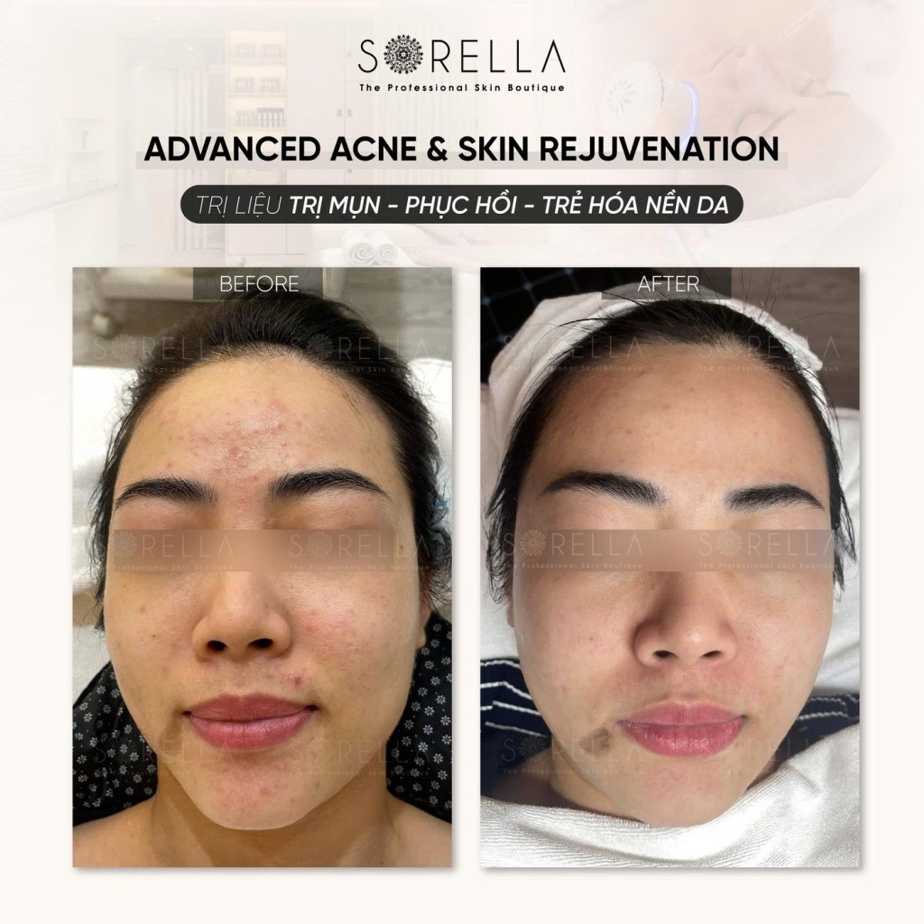 Before and after: Advanced Acne & Skin Rejuvenation at Sorella