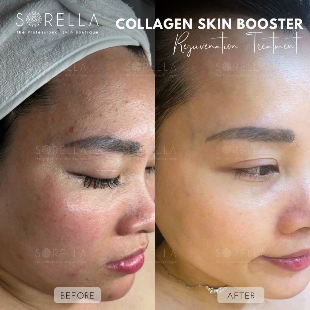 Before and after: Collagen Skin Booster at Sorella
