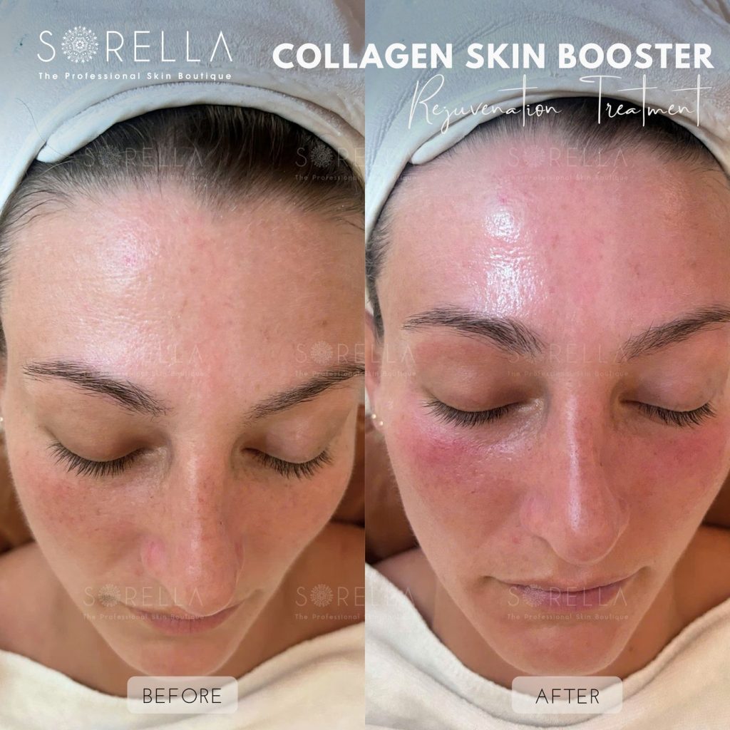 Before and after: Collagen Skin Booster at Sorella