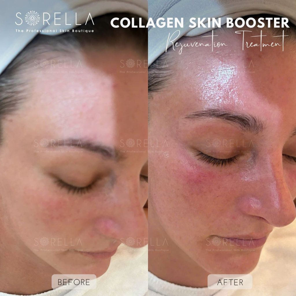 Before and after: Collagen Skin Booster at Sorella