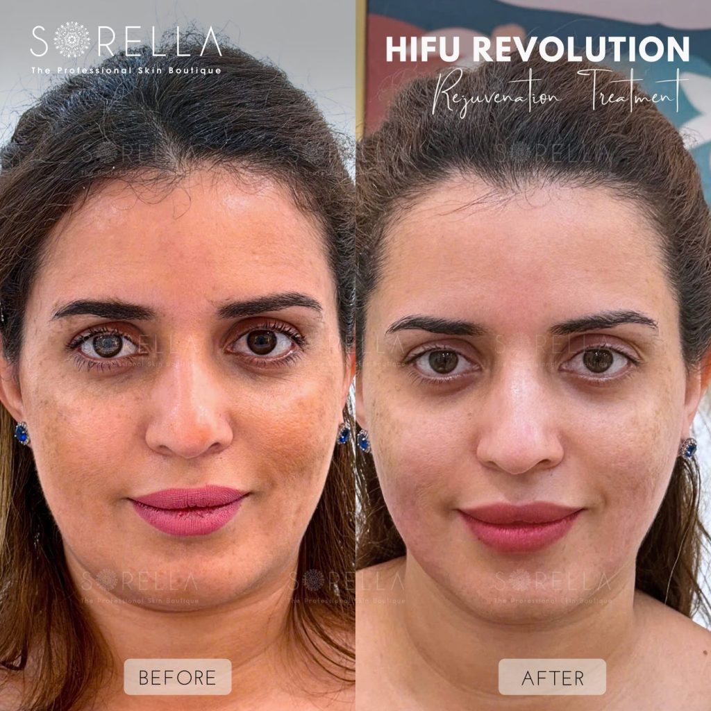 Before and after: HIFU Revolution at Sorella