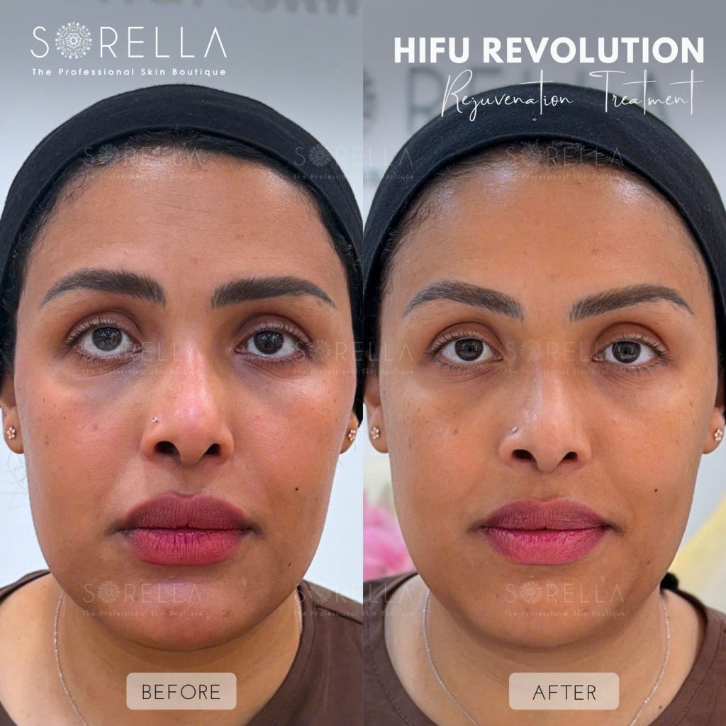 Before and after: HIFU Revolution at Sorella