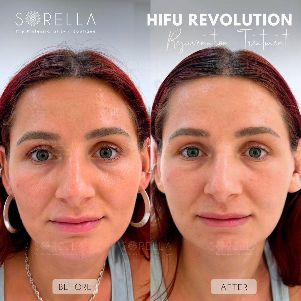 Before and after: HIFU Revolution at Sorella
