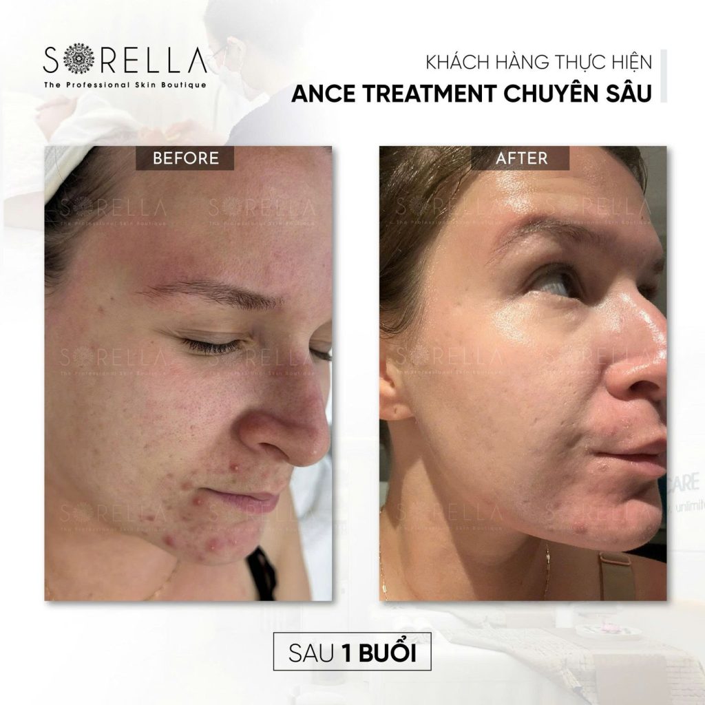 Before and after: Acne Treatment chuyên sâu at Sorella