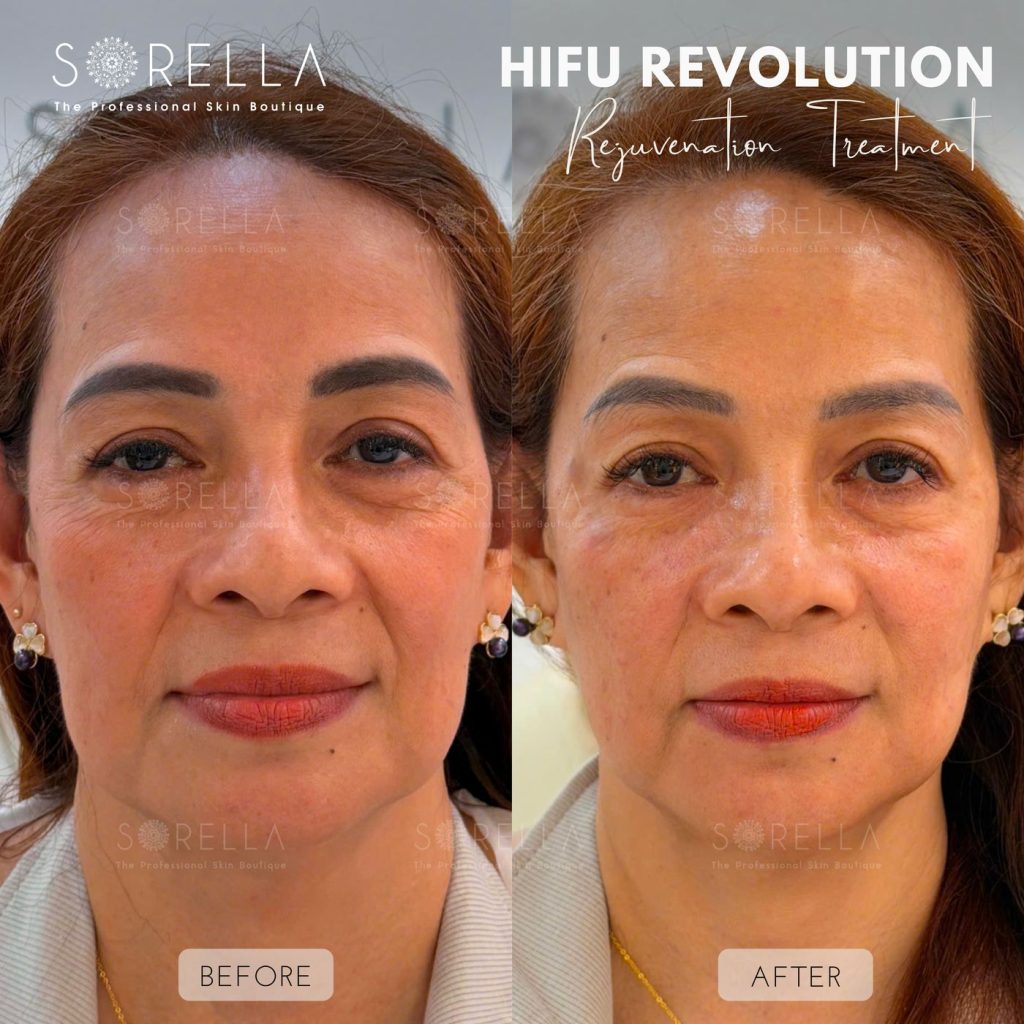 Before and after: HIFU Revolution at Sorella