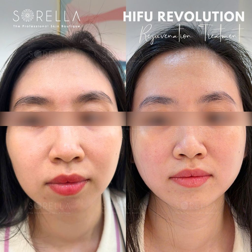 Before and after: HIFU Revolution at Sorella