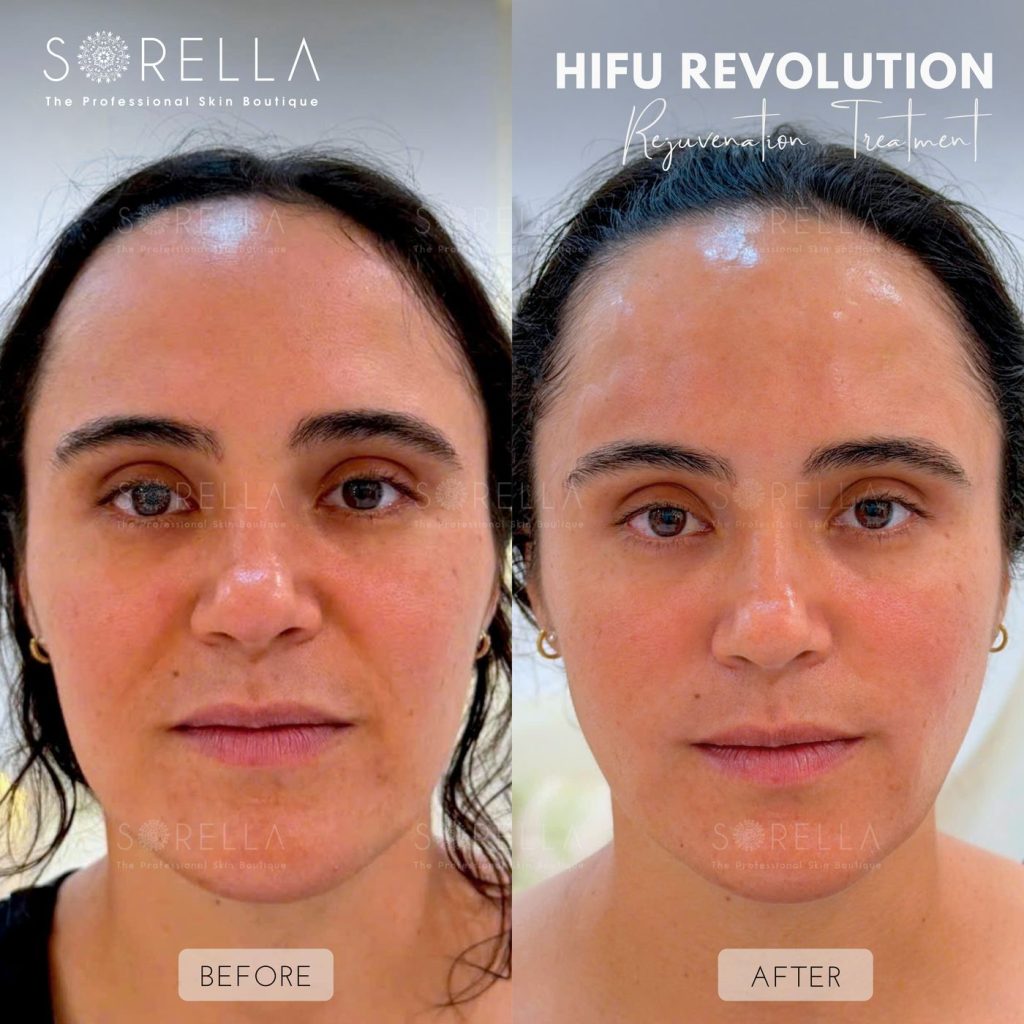 Before and after: HIFU Revolution at Sorella