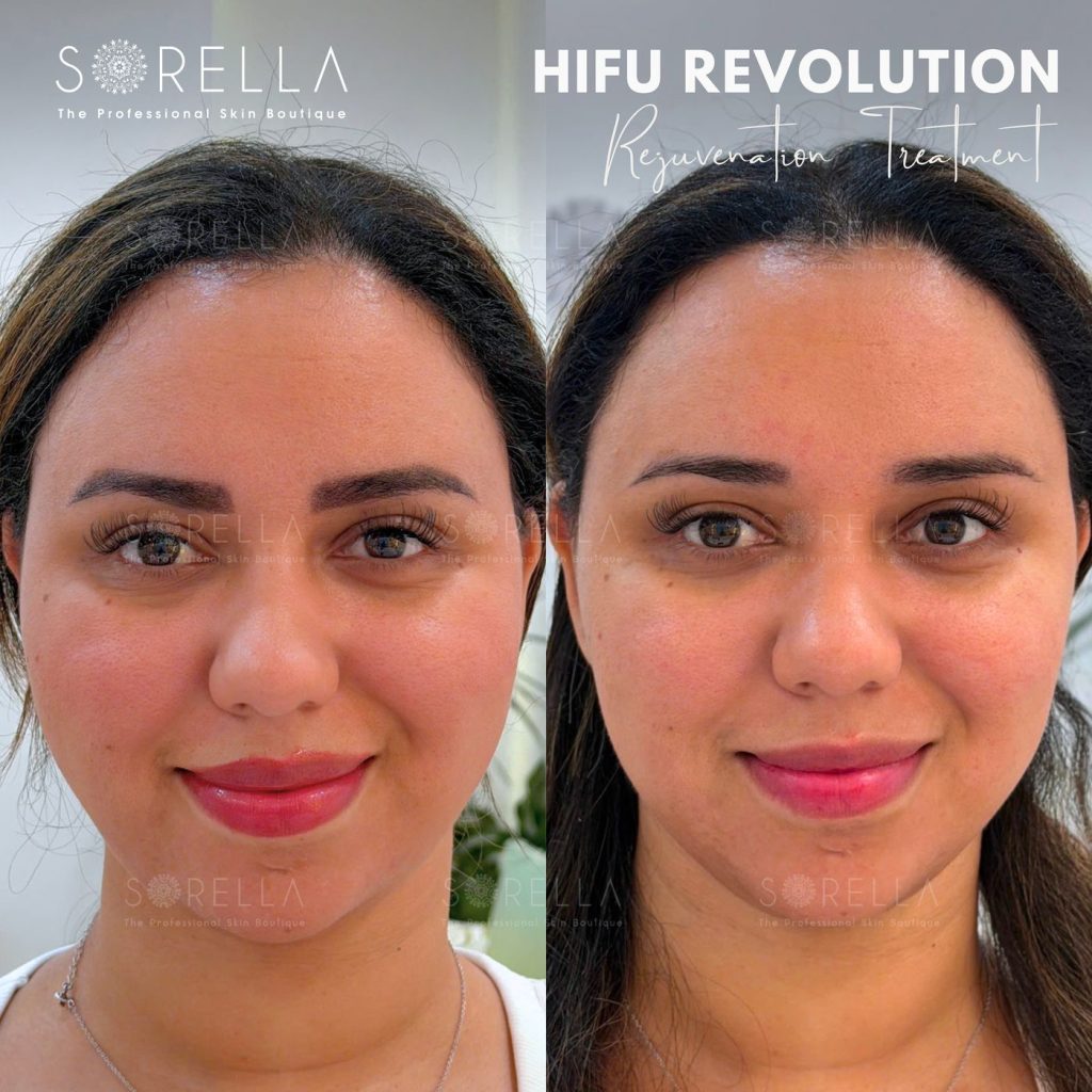 Before and after: HIFU Revolution at Sorella