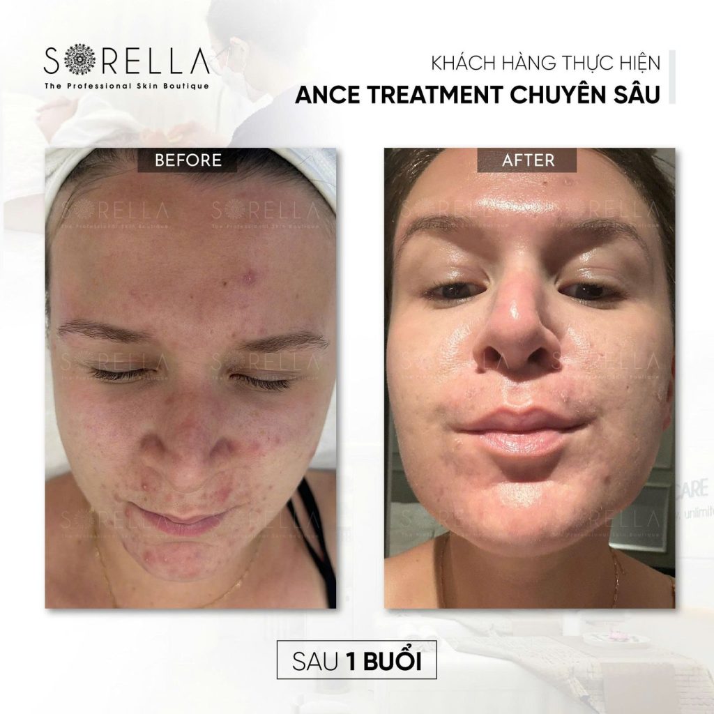 Before and after: Acne Treatment chuyên sâu at Sorella