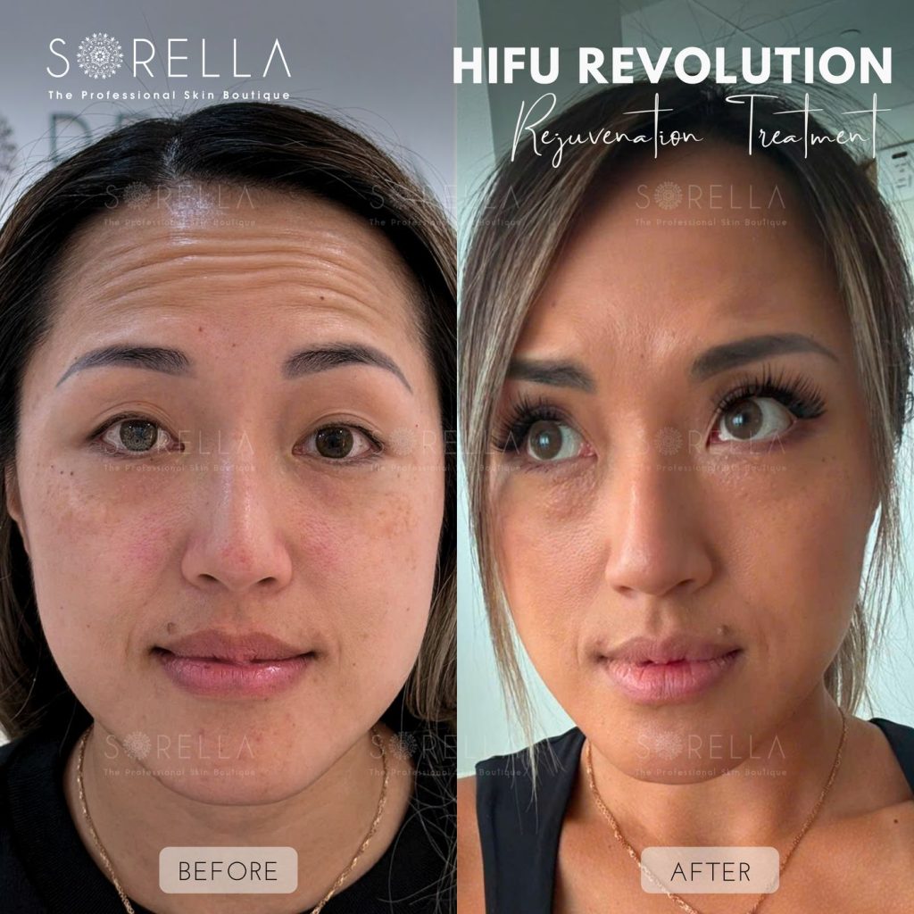 Before and after: HIFU Revolution at Sorella