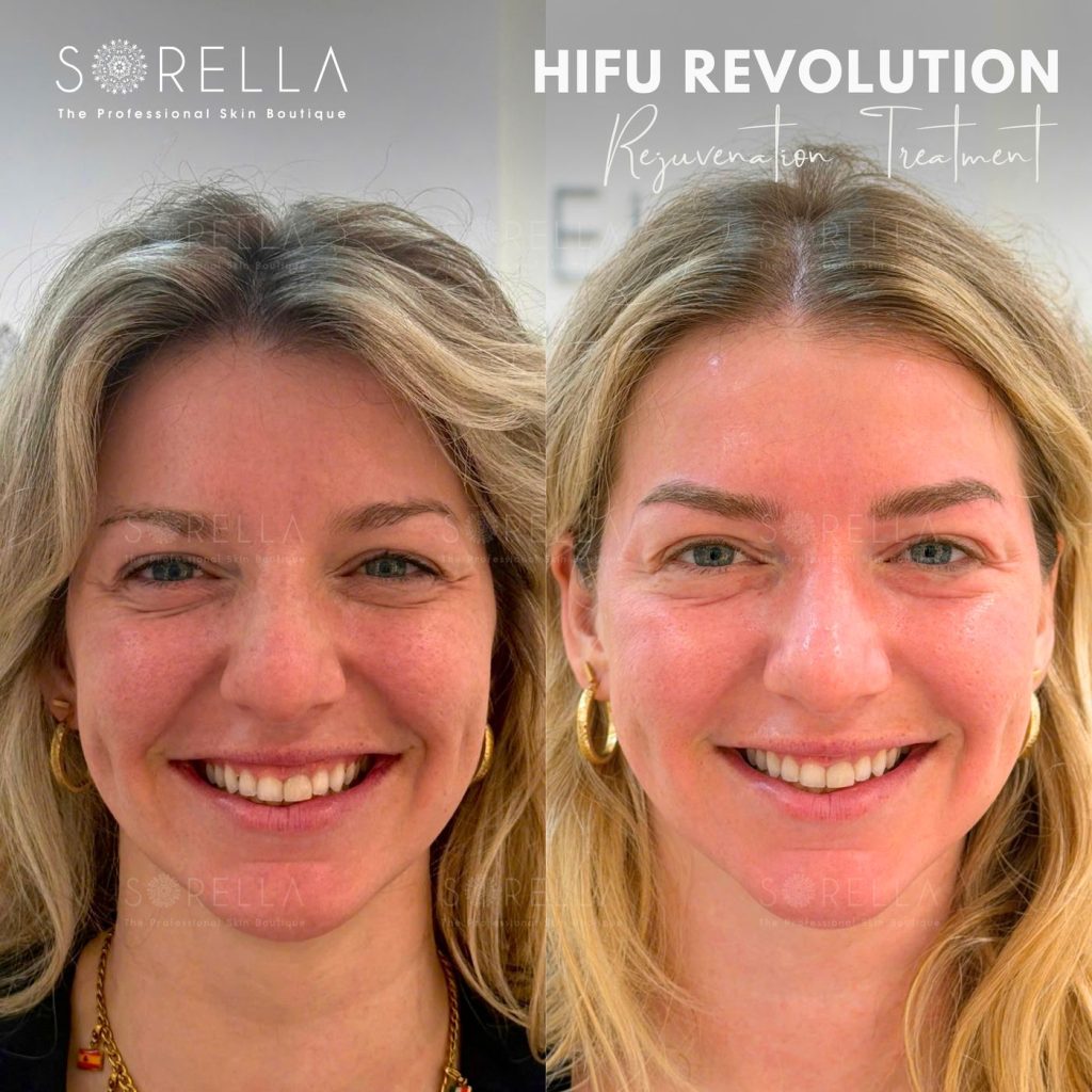 Before and after: HIFU Revolution at Sorella