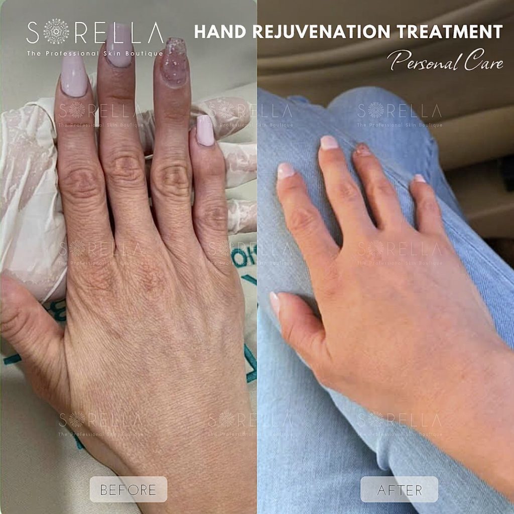 Before and after: Hand Rejuvenation Treatment at Sorella