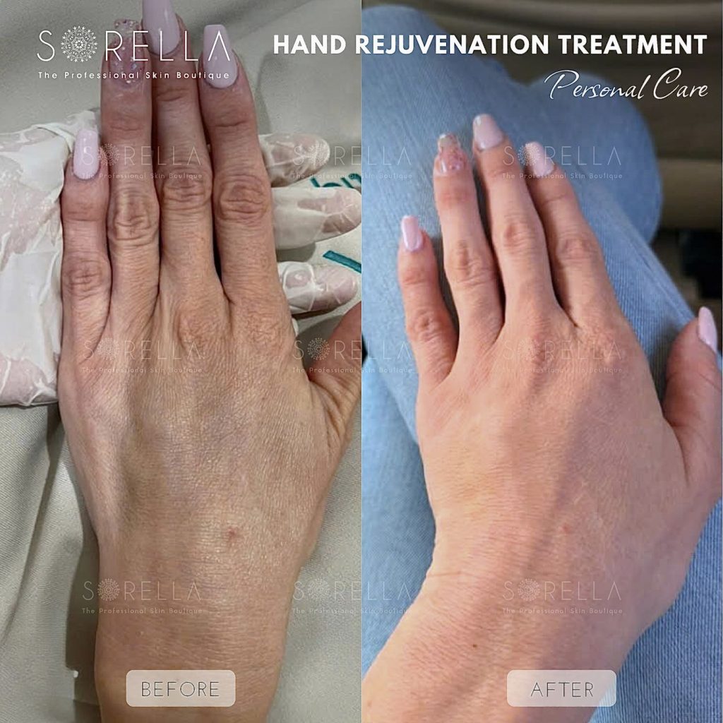 Before and after: Hand Rejuvenation Treatment at Sorella