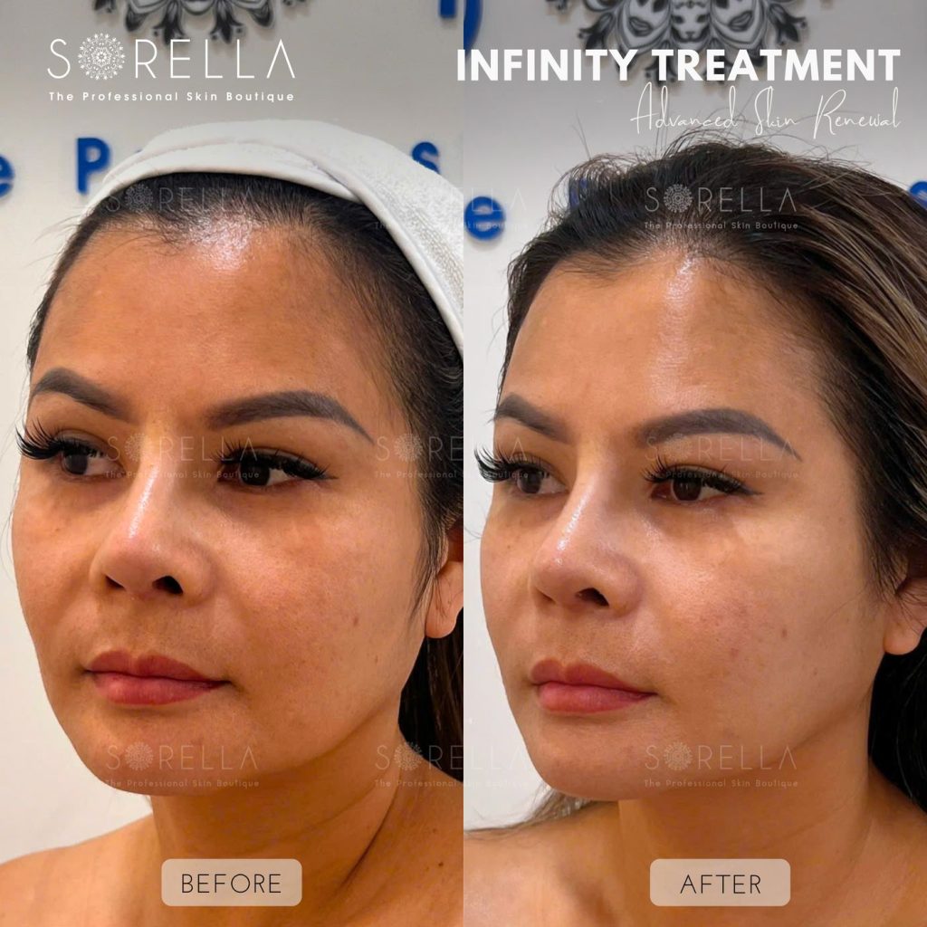 Before and after: Infinity Treatment at Sorella