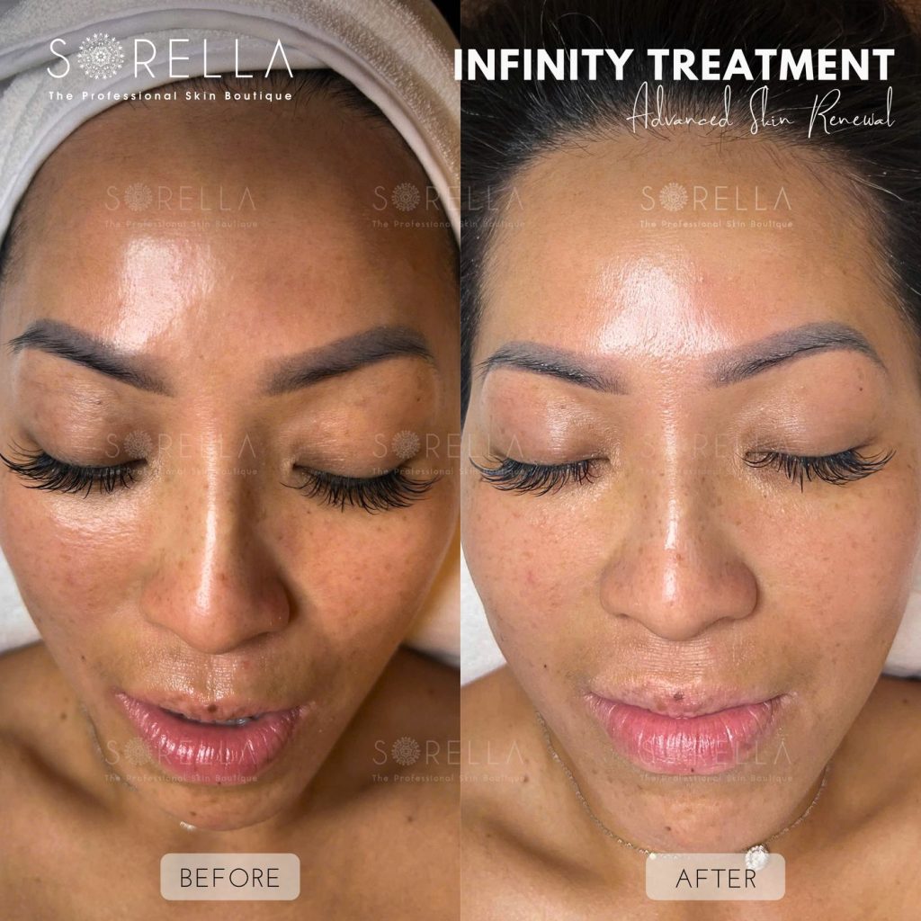 Before and after: Infinity Treatment at Sorella