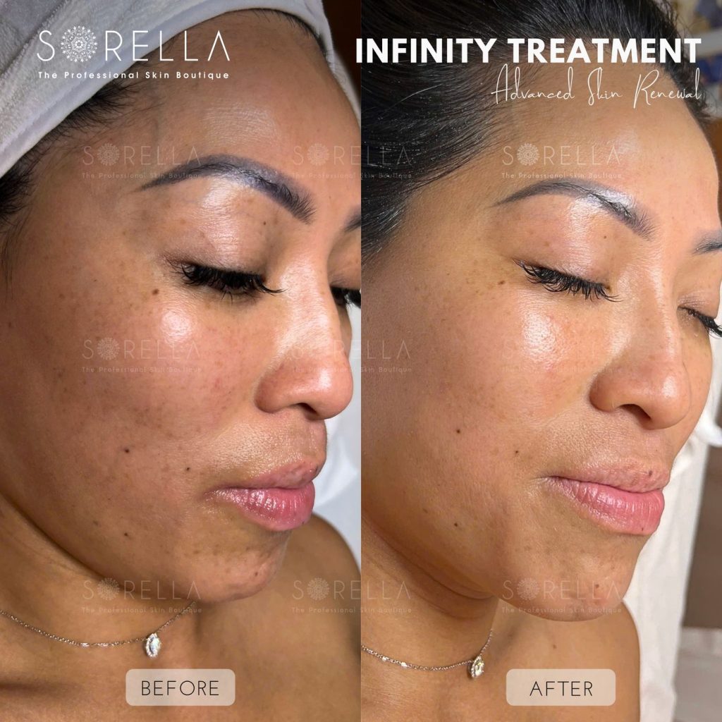 Before and after: Infinity Treatment at Sorella