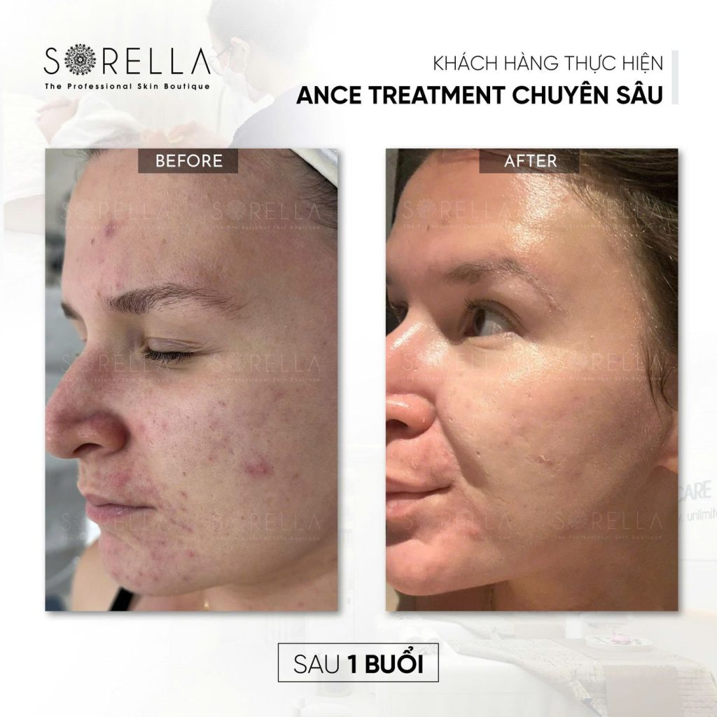 Before and after: Acne Treatment chuyên sâu at Sorella