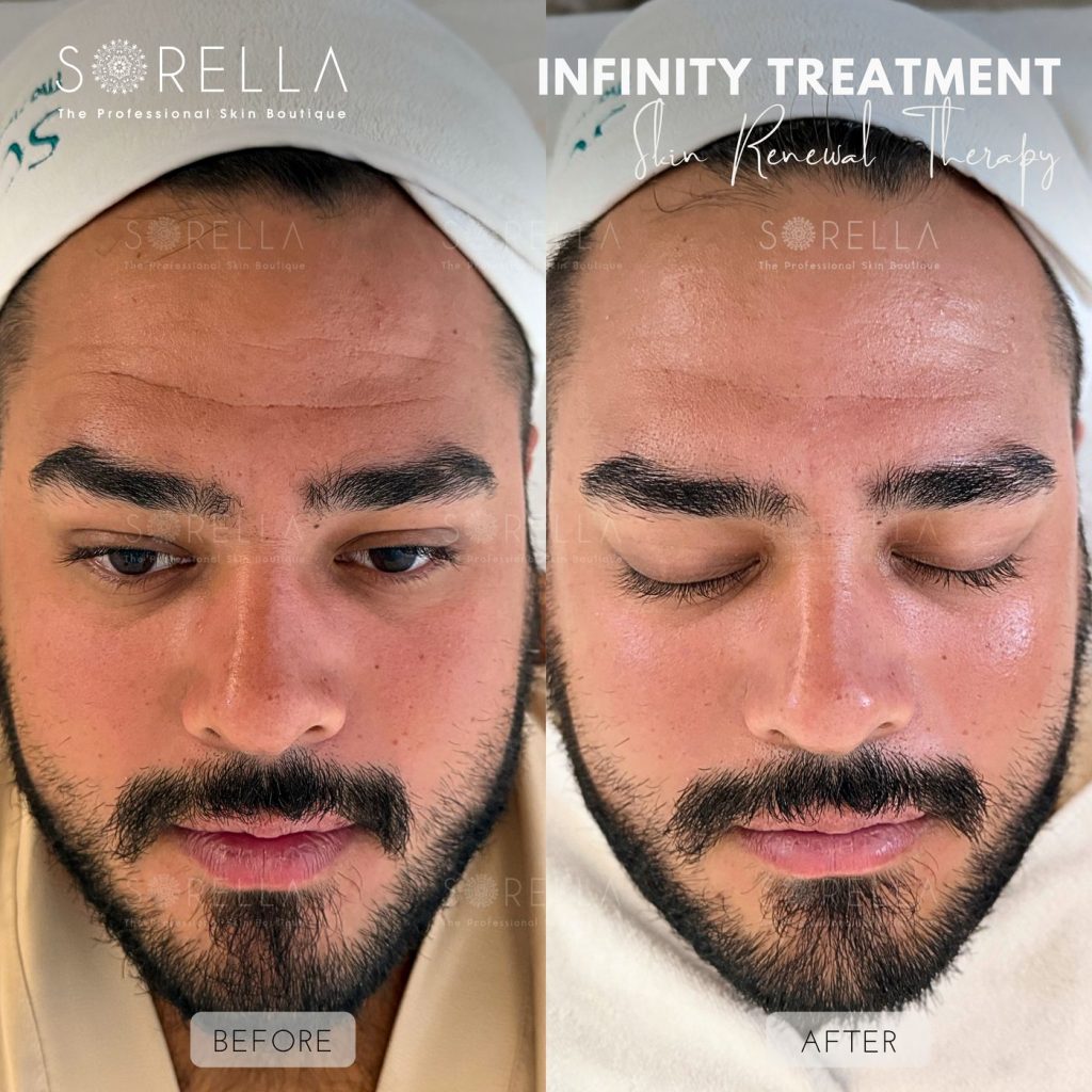 Before and after: Infinity Treatment at Sorella