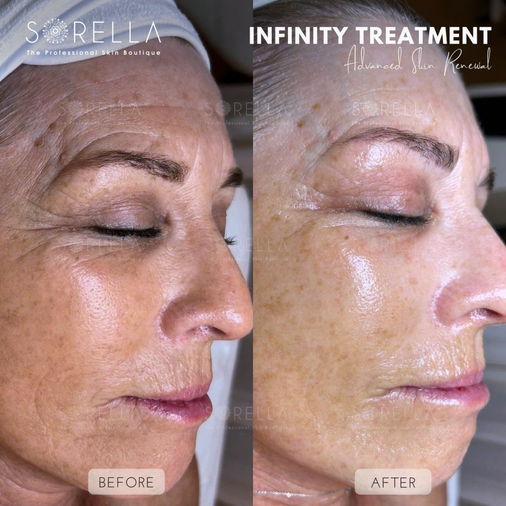 Before and after: Infinity Treatment at Sorella