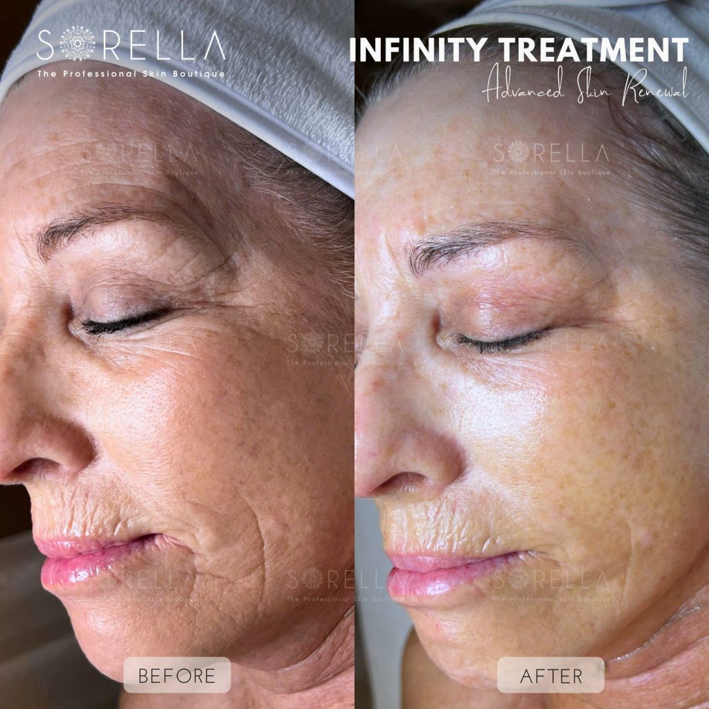 Before and after: Infinity Treatment at Sorella