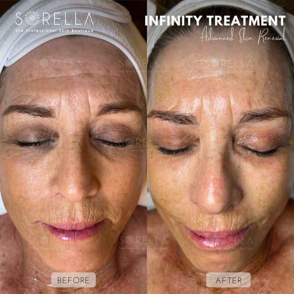 Before and after: Infinity Treatment at Sorella