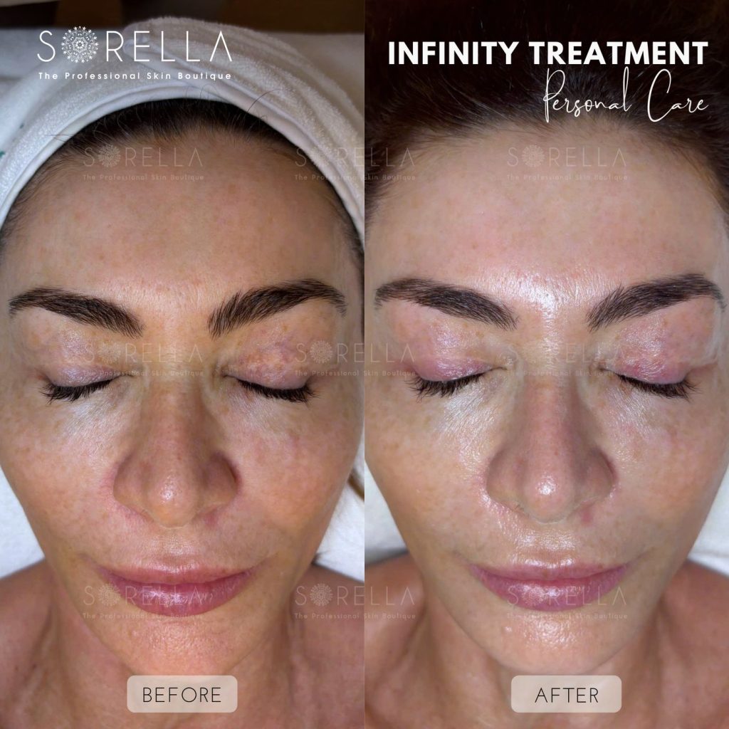 Before and after: Infinity Treatment at Sorella