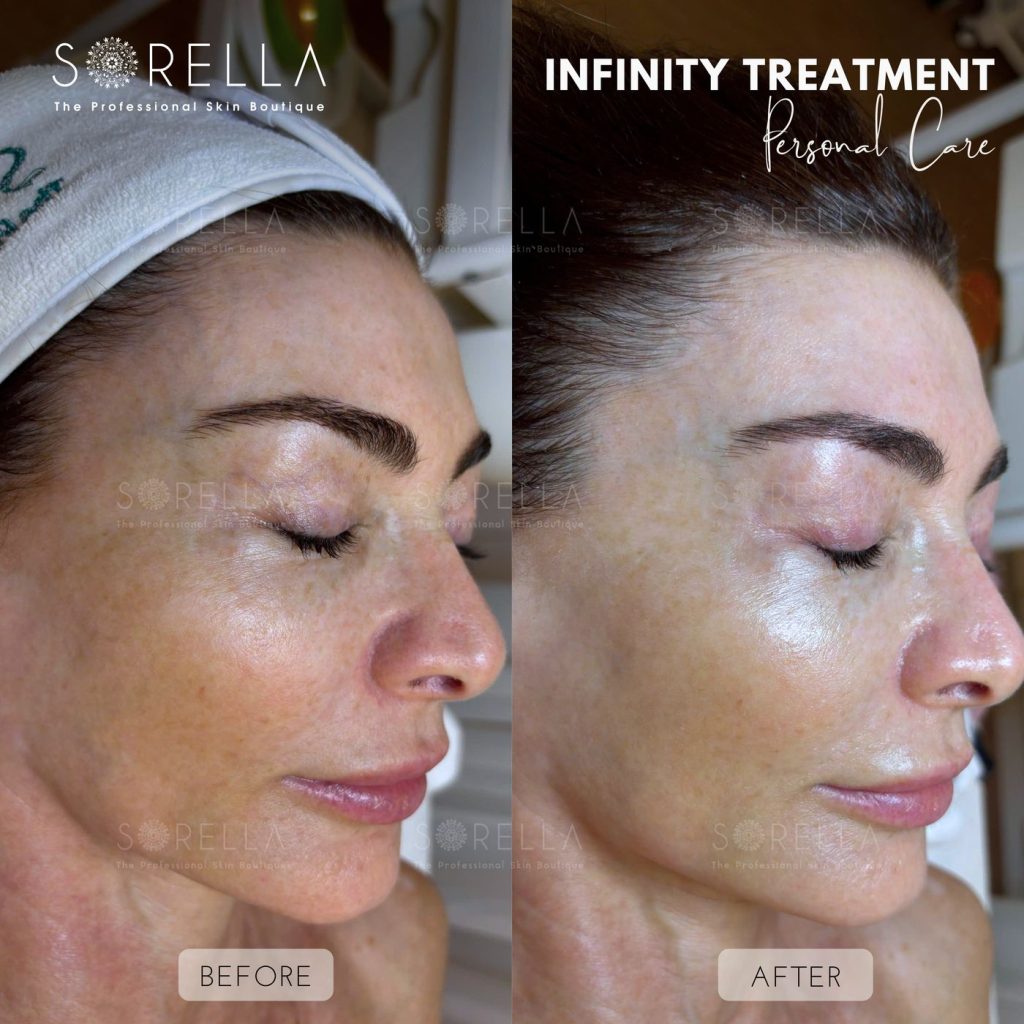 Before and after: Infinity Treatment at Sorella