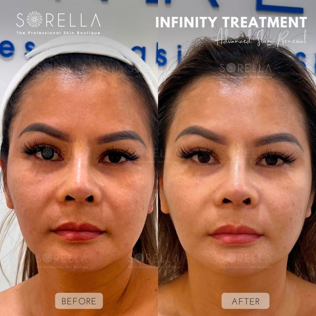 Before and after: Infinity Treatment at Sorella