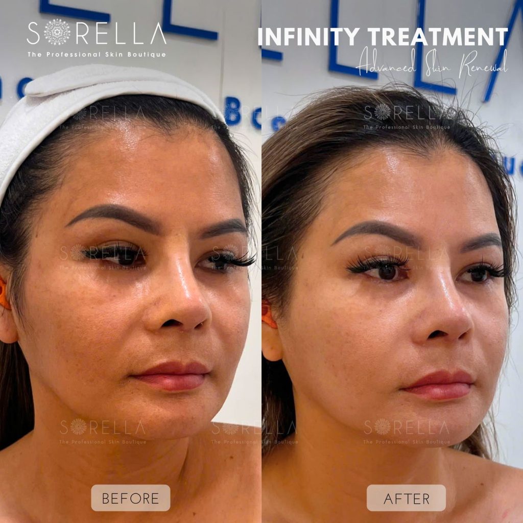 Before and after: Infinity Treatment at Sorella