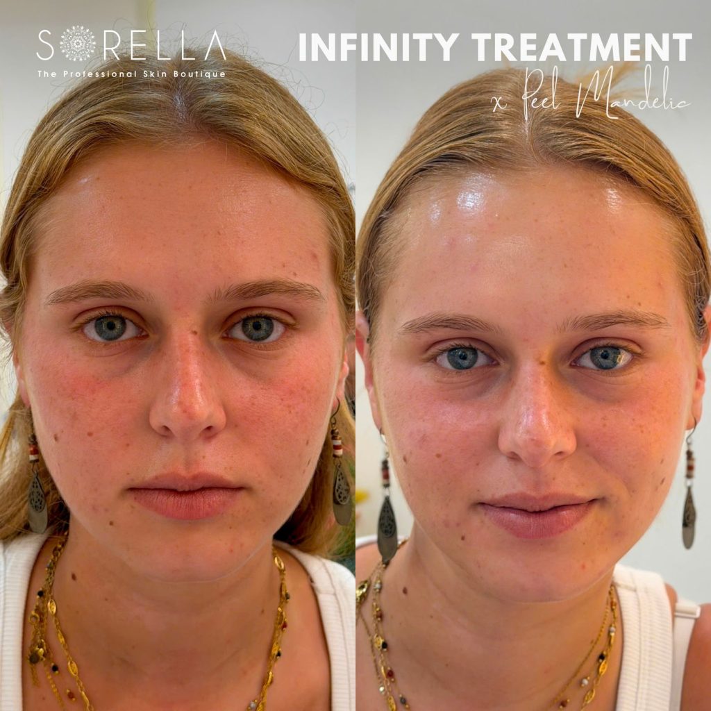 Before and after: Infinity Treatment at Sorella