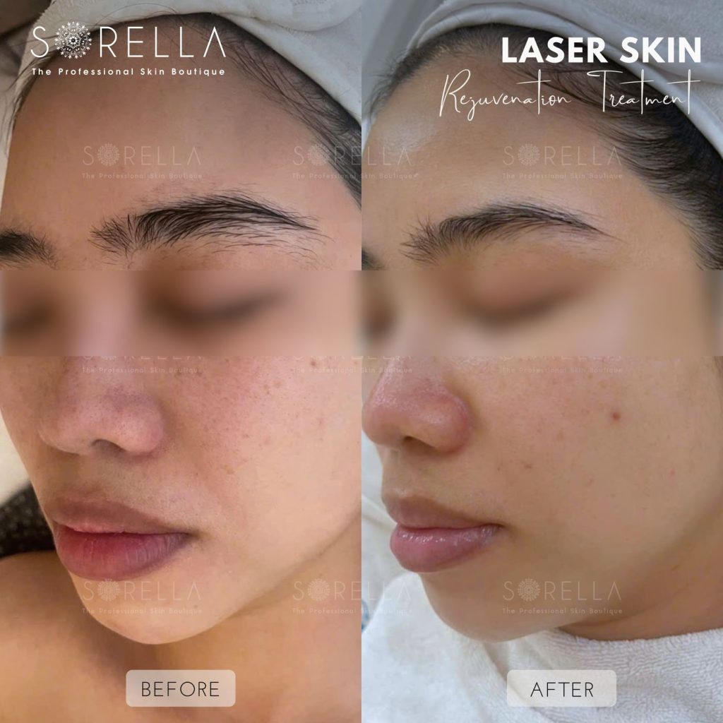 Before and after: Laser Skin at Sorella