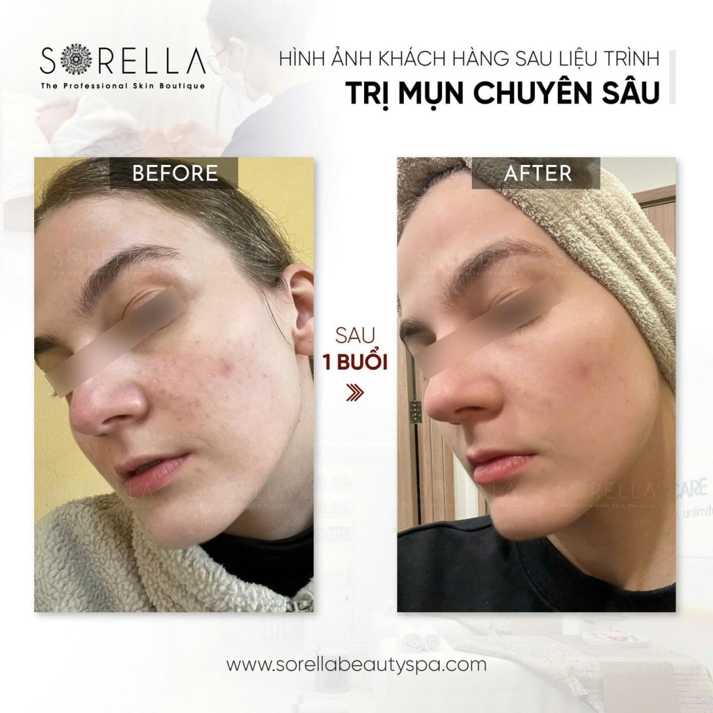Before and after: Trị mụn chuyên sâu at Sorella
