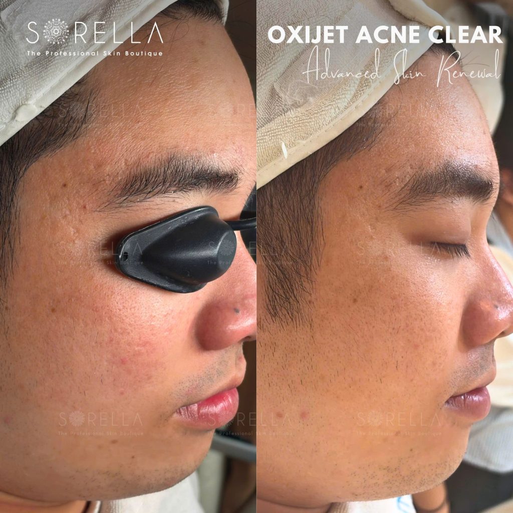 Before and after: Oxijet Acne Clear at Sorella