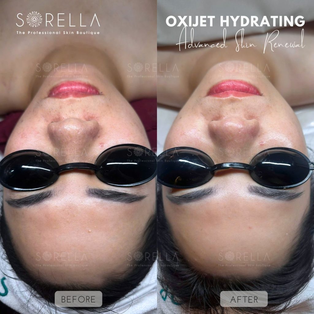 Before and after: Oxijet Hydrating at Sorella