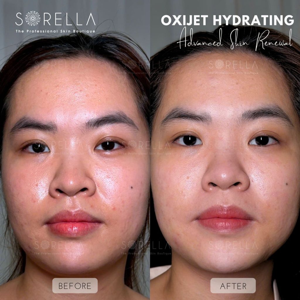 Before and after: Oxijet Hydrating at Sorella