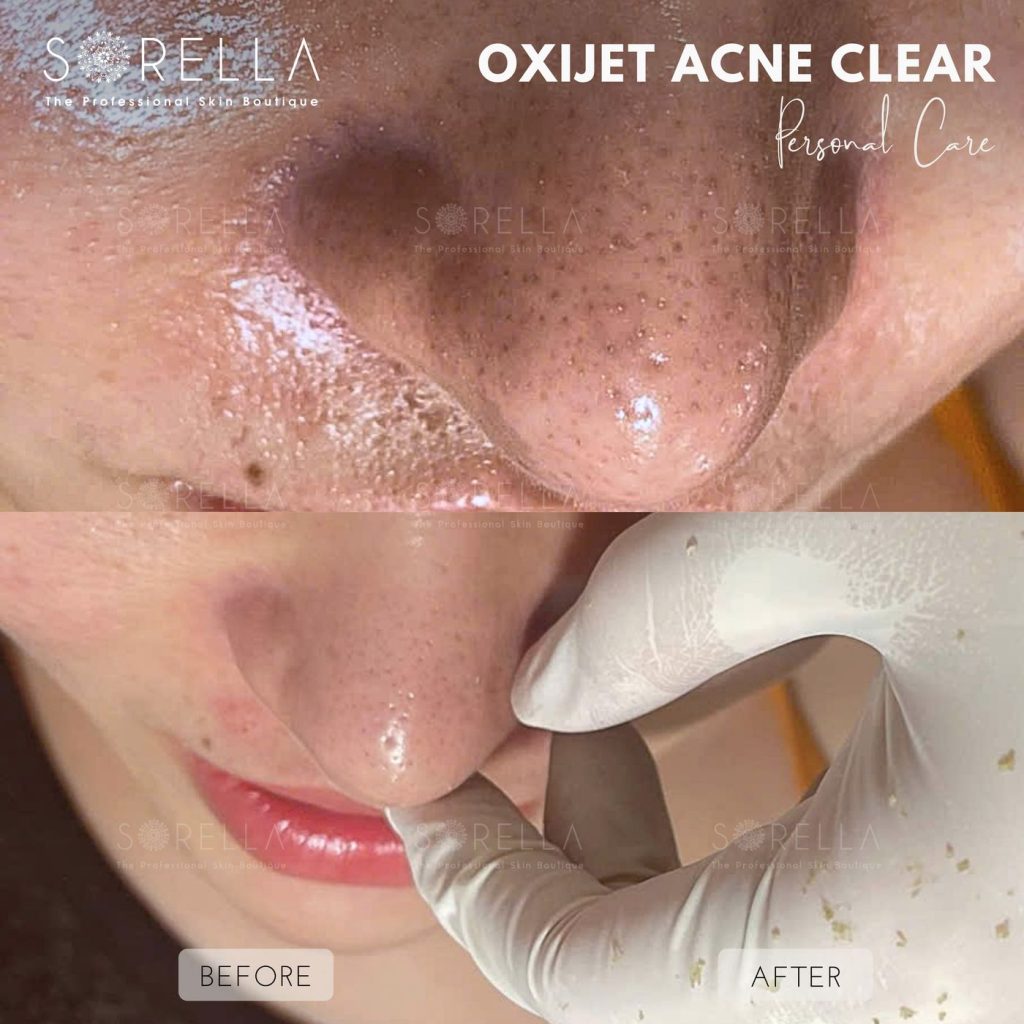 Before and after: Oxijet Acne Clear at Sorella