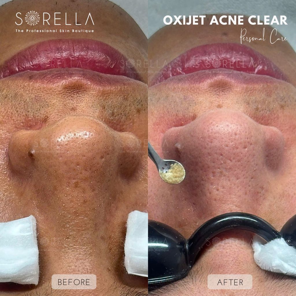 Before and after: Oxijet Acne Clear at Sorella
