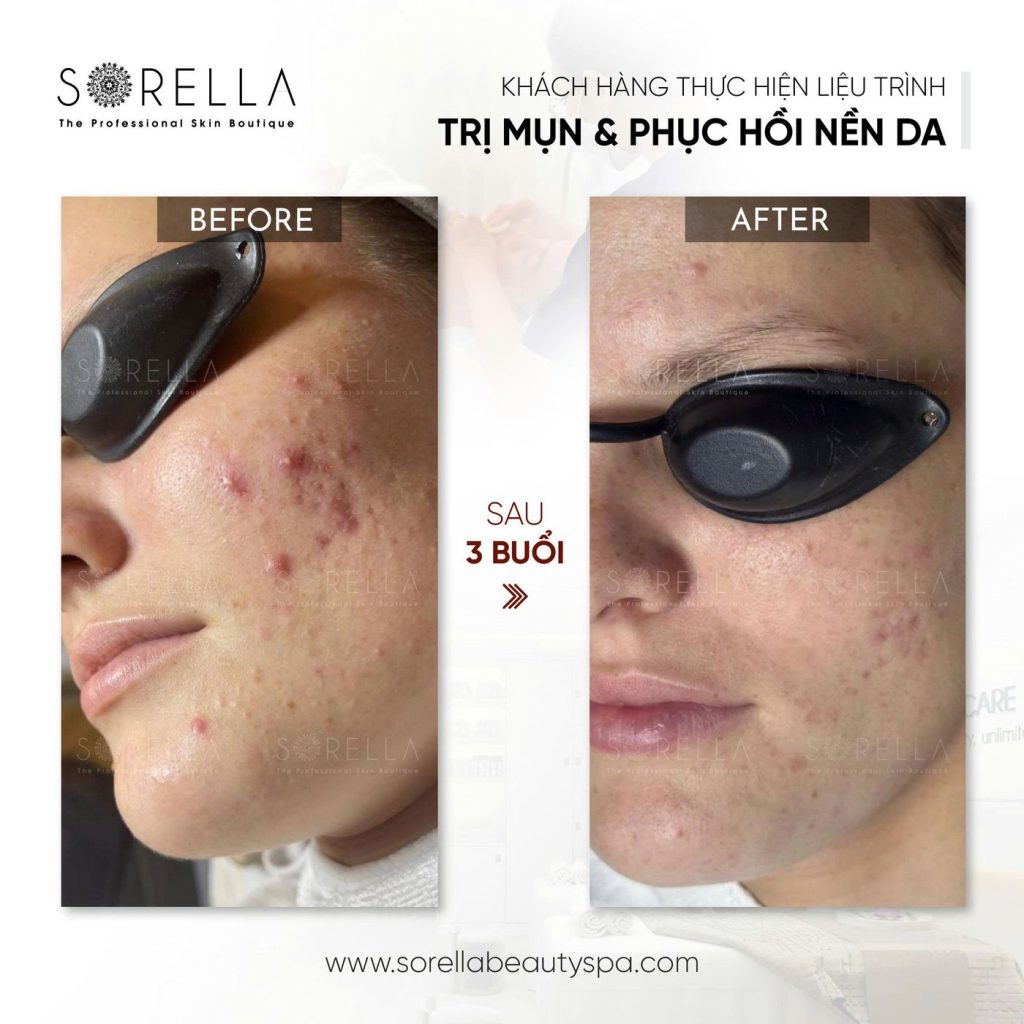 Before and after: Trị mụn & phục hồi nền da at Sorella