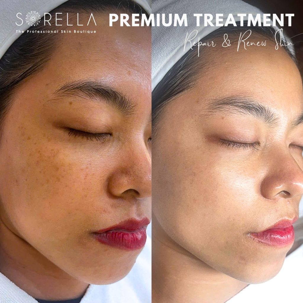 Before and after: Premium Treatment – Repair & Renew at Sorella