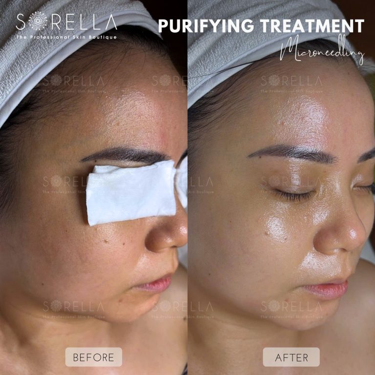 Purifying Treatment - before and after 13