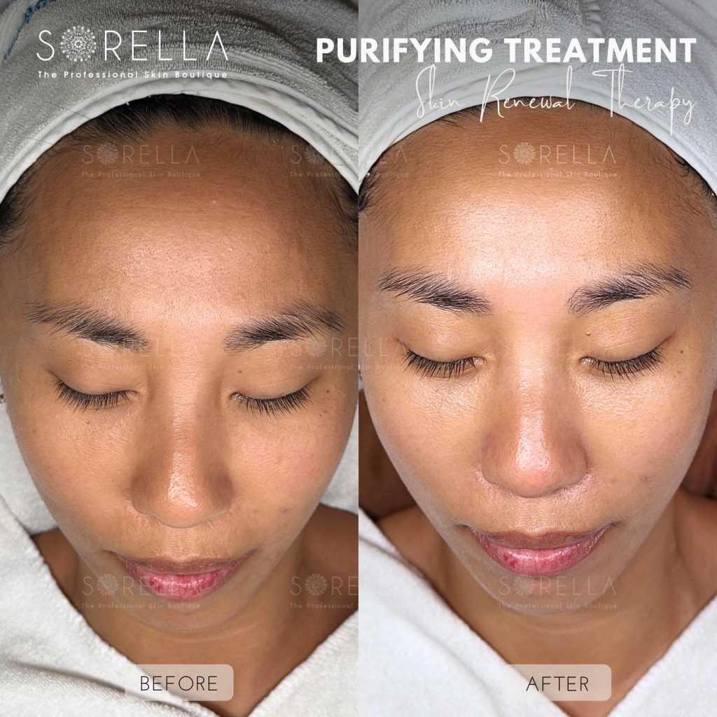 Before and after: Purifying Treatment at Sorella