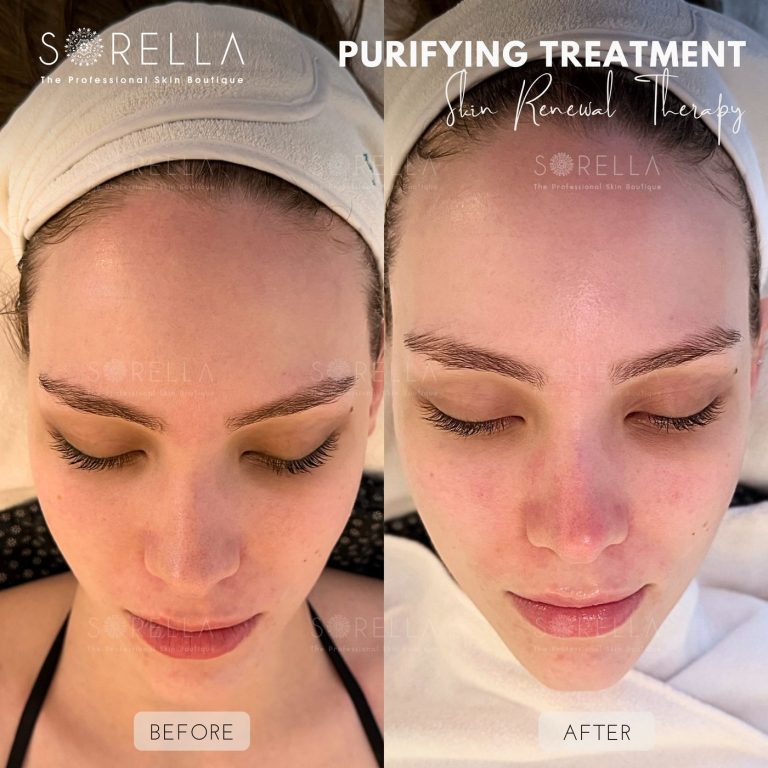 Purifying Treatment - before and after 2