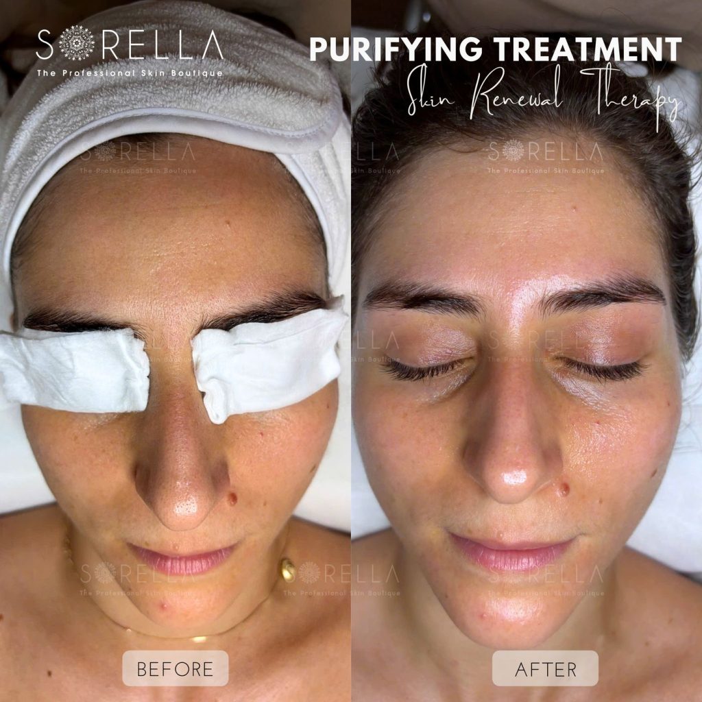 Before and after: Purifying Treatment at Sorella