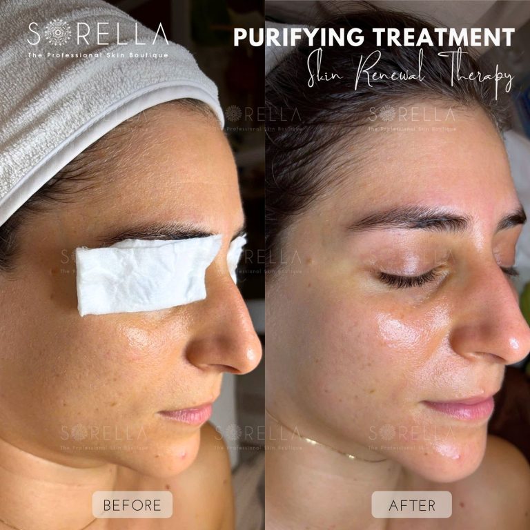 Purifying Treatment - before and after 4