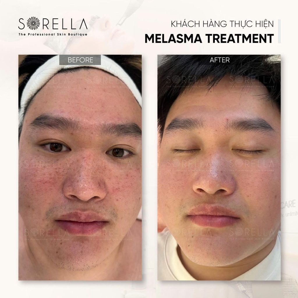 Before and after: Melasma Treatment at Sorella