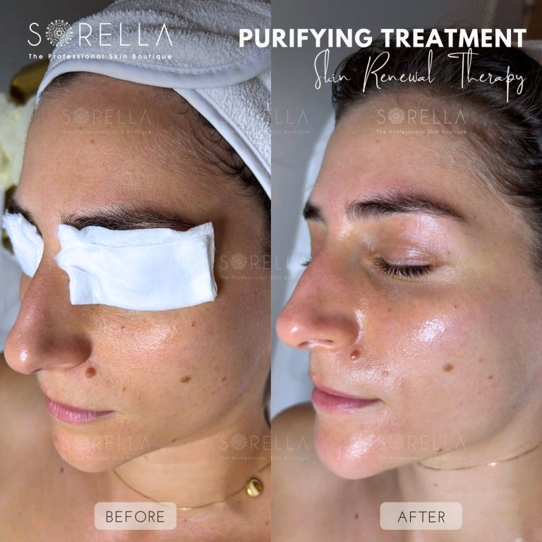 Purifying Treatment - before and after 5